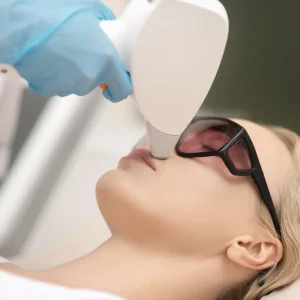 Depilación laser de bigote